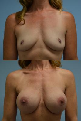 Breast Reconstruction with Tissue Expander