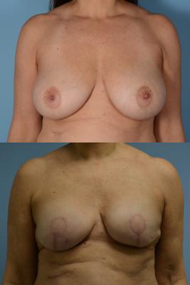 Breast Reconstruction with Tissue Expander
