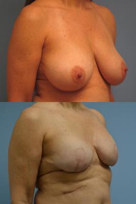 Breast Reconstruction with Tissue Expander
