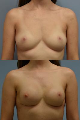 Breast Reconstruction with Tissue Expander