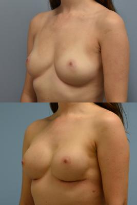Breast Reconstruction with Tissue Expander