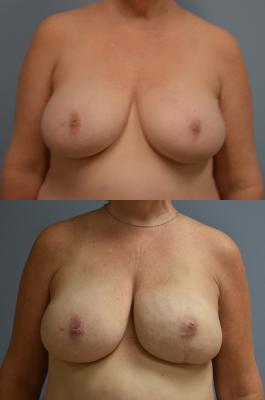 Breast Reconstruction with Tissue Expander