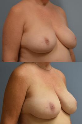 Breast Reconstruction with Tissue Expander
