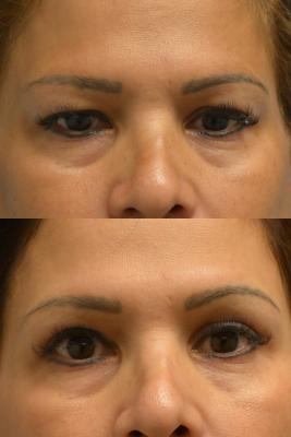 Upper Blepharoplasty, Ptosis Repair, Brow Lift