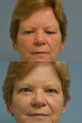 Upper Bleph and Brow Lift