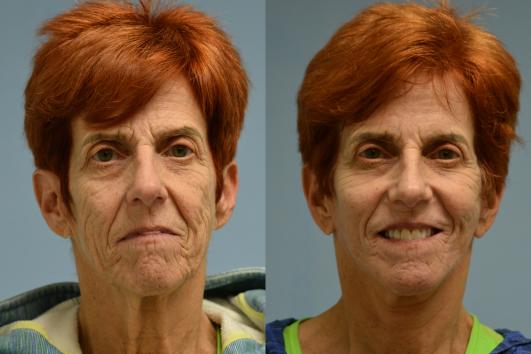 Face and Neck lift with Upper Blepharoplasty and Brow Lift