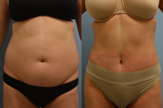 Tummy tuck