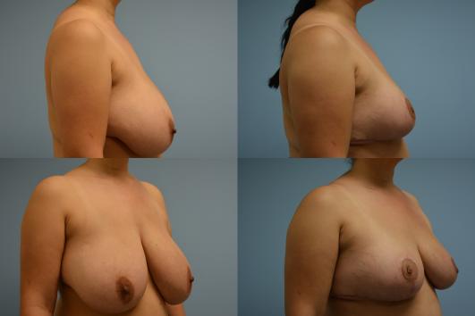Breast Reduction