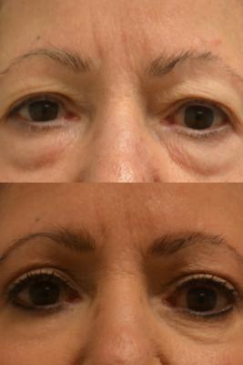 Eyelid Surgery