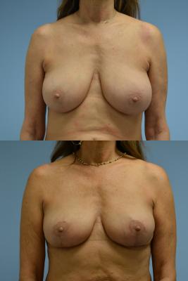 Breast Reduction