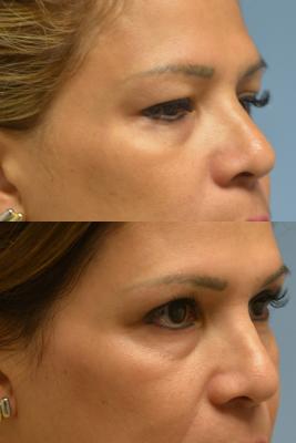 Upper Blepharoplasty, Ptosis Repair, Brow Lift