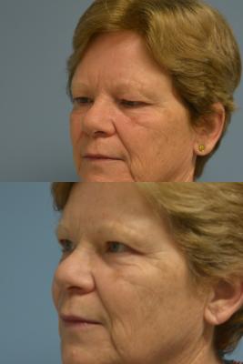 Upper Bleph and Brow Lift