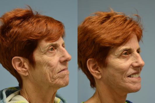 Face and Neck lift with Upper Blepharoplasty and Brow Lift