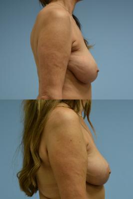 Breast Reduction