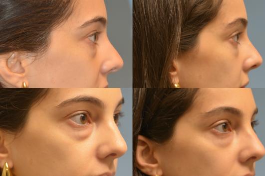 Lower Blepharoplasty
