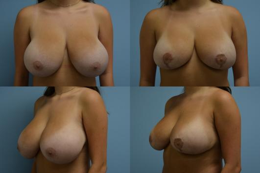 Breast Reduction