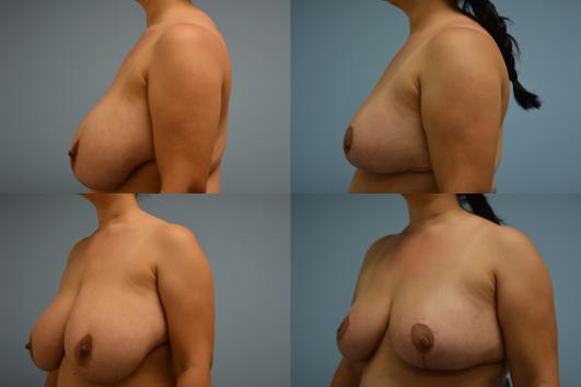Breast Reduction