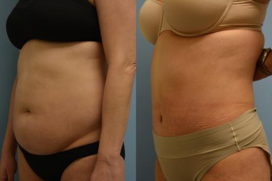 Tummy Tuck