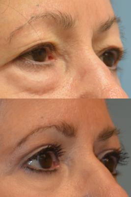 Eyelid Surgery