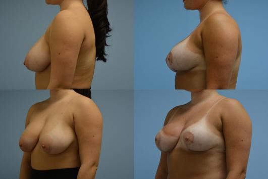 Breast Reduction