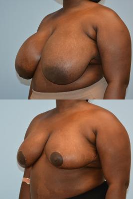 Breast Reduction
