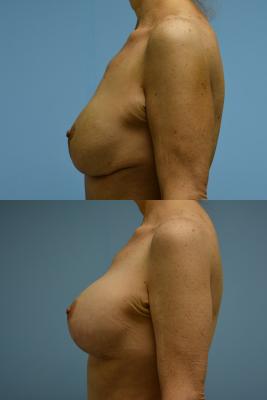 Breast Augmentation and Lift