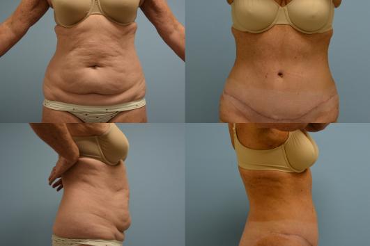 Lipo Abdominoplasty