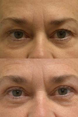 Upper Blepharoplasty