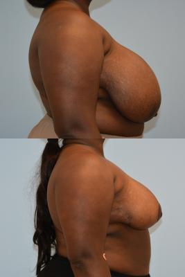 Breast Reduction