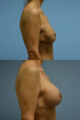 Breast Augmentation and Lift