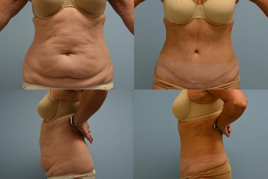 Lipo Abdominoplasty