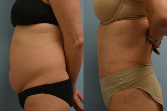 Tummy Tuck