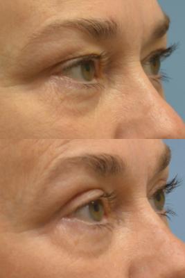 Upper Blepharoplasty