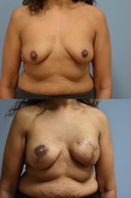 Breast Reconstruction with Tissue Expander