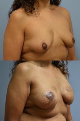 Breast Reconstruction with Tissue Expander