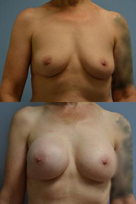 Breast Reconstruction with Tissue Expander