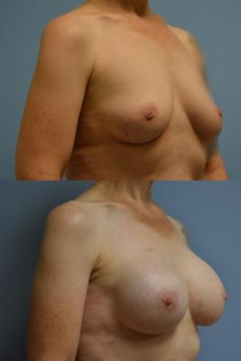 Breast Reconstruction with Tissue Expander