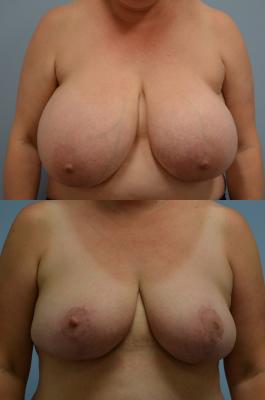 Breast Reduction