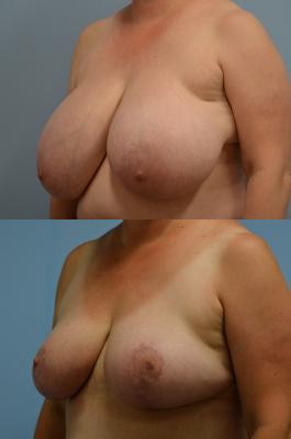 Breast Reduction