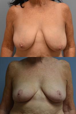 Breast Reduction
