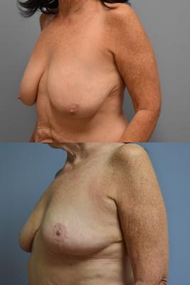 Breast Reduction