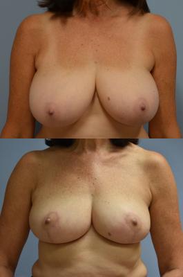 Bilateral Breast Reduction