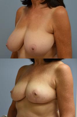 Bilateral Breast Reduction