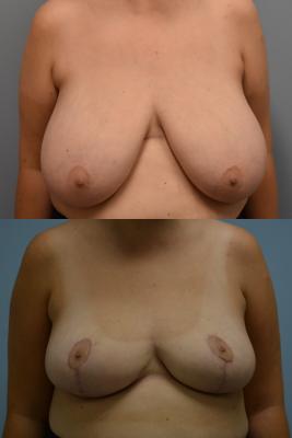 Breast Reduction