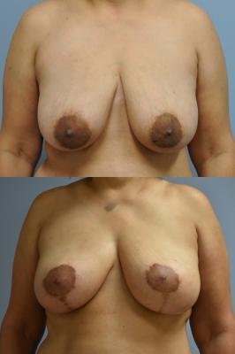 Oncoplastic Breast Reduction