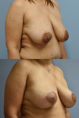 Oncoplastic Breast Reduction