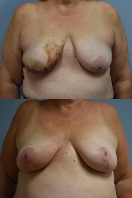 Oncoplastic Breast Reduction