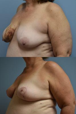 Oncoplastic Breast Reduction
