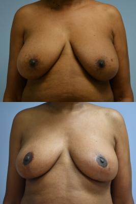 Oncoplastic Breast Reduction