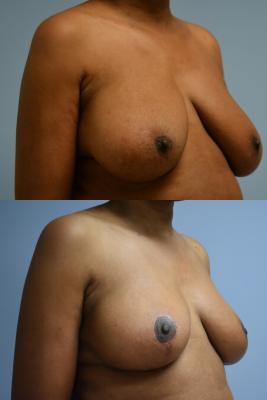 Oncoplastic Breast Reduction